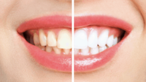 ホワイトニングのBeforeAfter